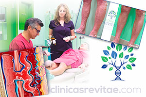 Franquicia Clinicas Revitae fleboterapia